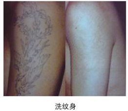 洗纹身的机子慈溪哪里有卖