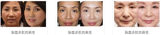 圣爱胎盘多肽抗衰老真人案例对比图